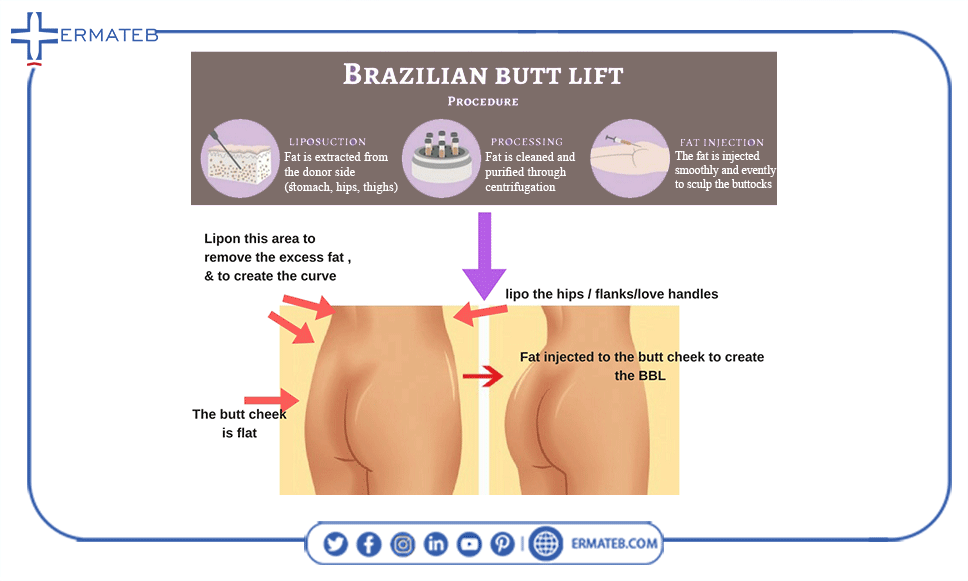 Brazilian butt lift process